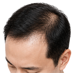 남성형탈모